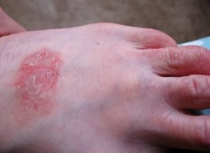 Eczema